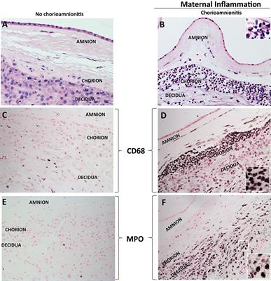 Immunobiology of Acute Chorioamnionitis